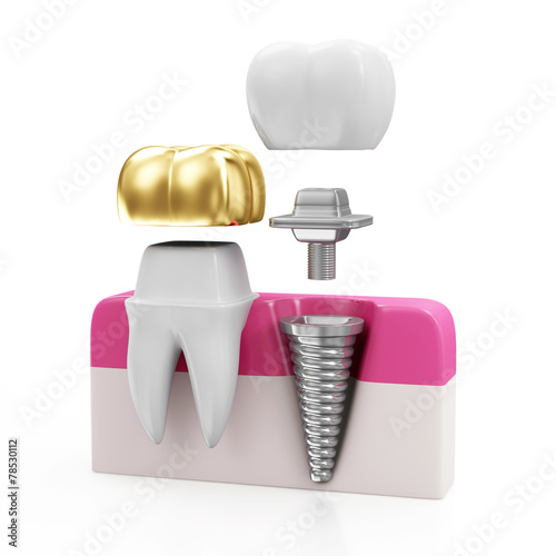 Tooth with Golden Dental Crown and Dental implant