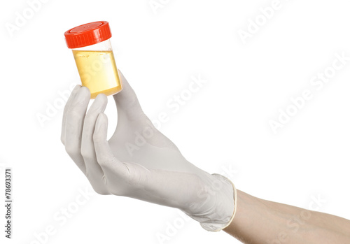 hand doctor in white gloves holding container of urine analysis