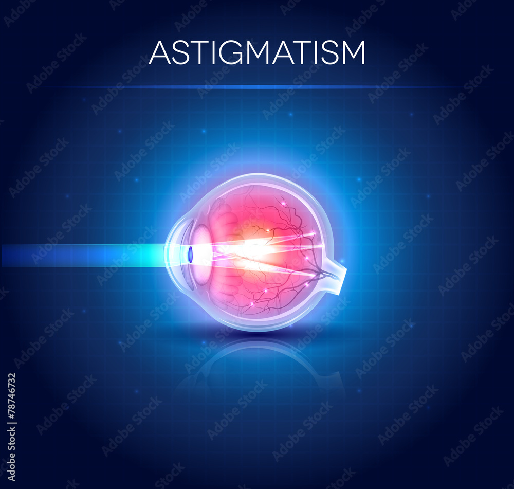 Astigmatism eyesight disorder. Anatomy of the eye, cross section Stock
