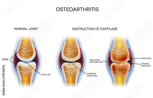 Osteoarthritis, destruction of cartilage