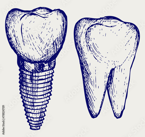 Tooth implant and molar. Doodle style