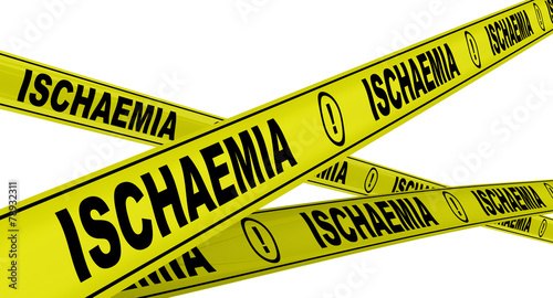 Ишемия (ischaemia). Желтая оградительная лента