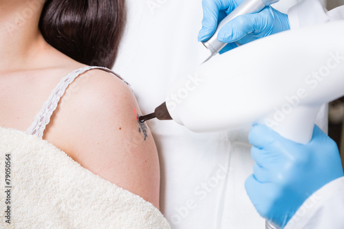 Tattoo, entfernen, Arm