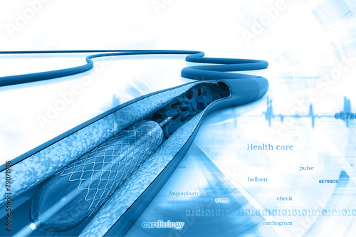 Stent angioplasty procedure with placing a balloon