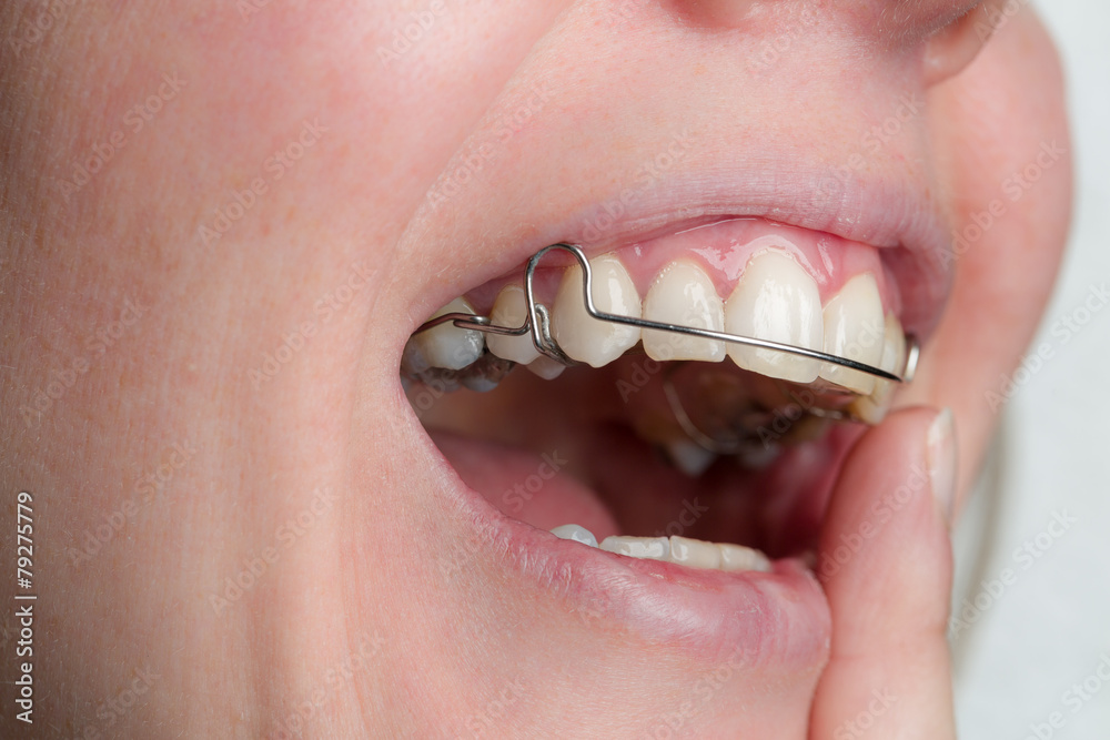 Obraz premium Zahnspange wird eingesetzt