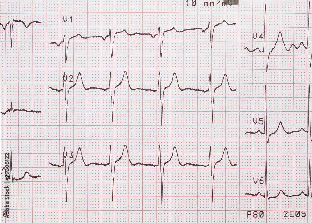 Electrocardiogram, ECG printout, EKG background