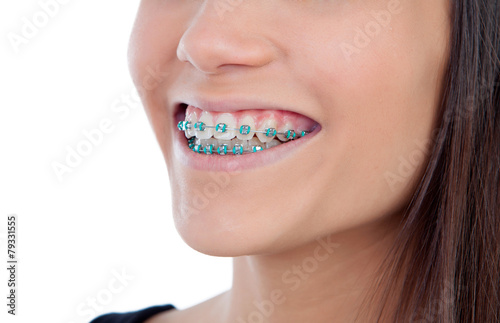 Attractive young woman with brackets