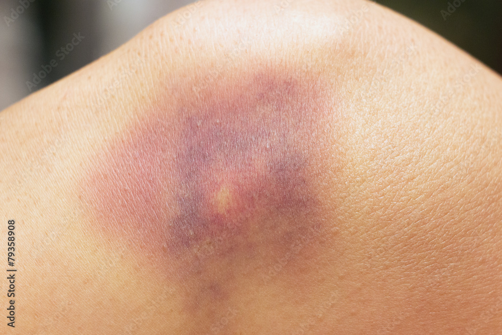 Bluterguss am Knie Bluterguss am Knie