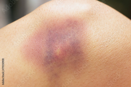 Bluterguss am Knie