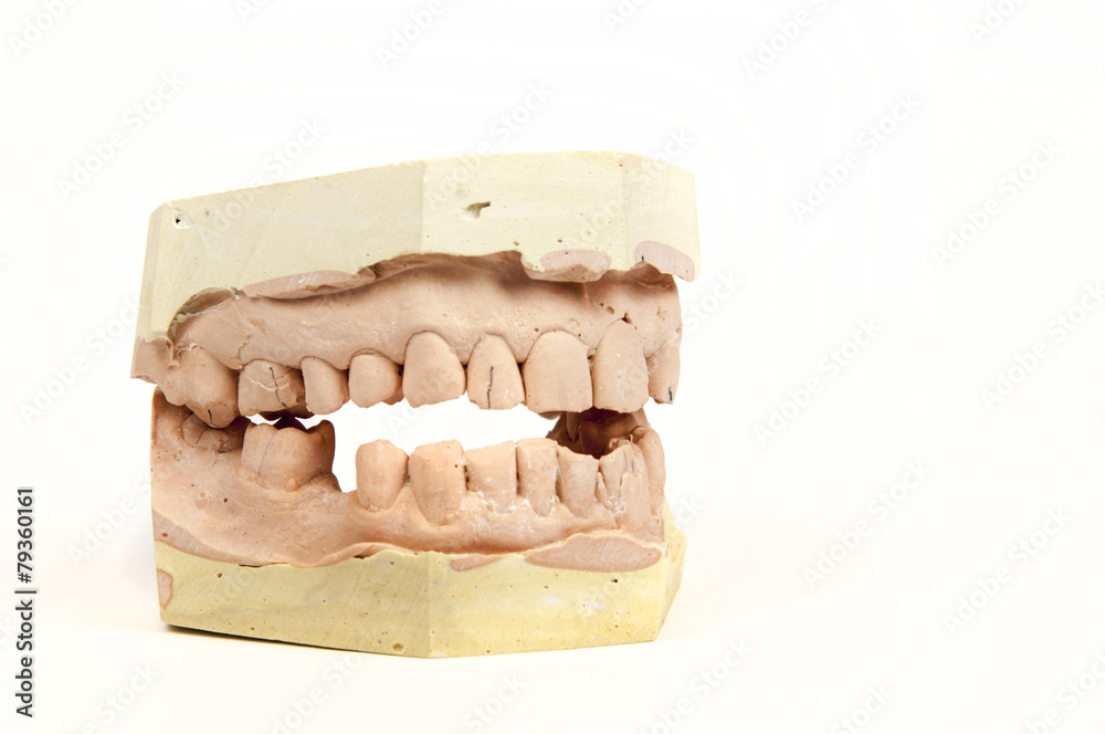 plaster cast of a human jaw plaster cast of a human jaw