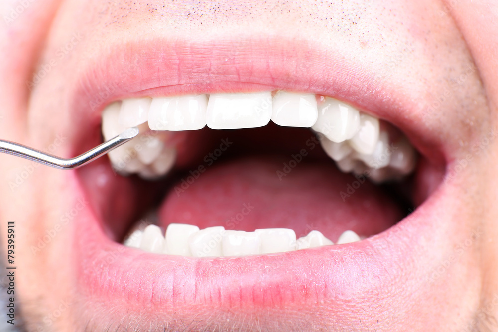 Obraz premium Examine of man by dentist with dental mirror, macro view