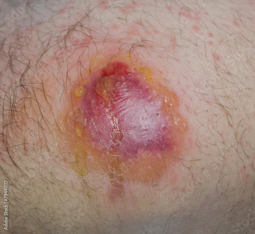allergic dermatitis