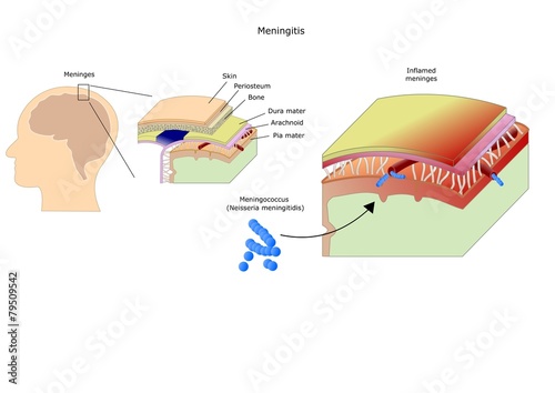 Meningitis: inflammation of the brain by bacteria, virus, fungi