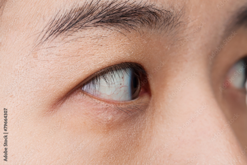 Fototapeta premium Eye injury or infected for healthy concept, macro closeup