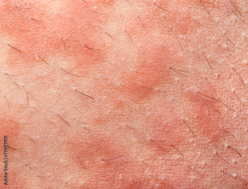 Eczema atopic dermatitis