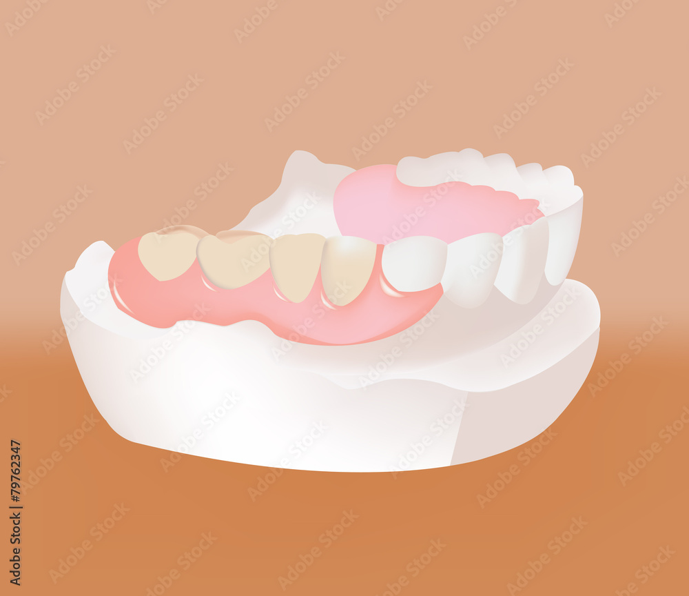 calco dentale ponte calco dentale ponte