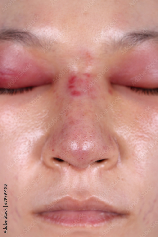 nose and eye swelll after nose job nose and eye swelll after nose job