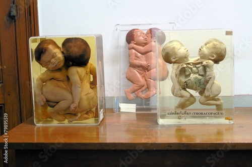 Conjoined Twins Forensic Exhibit photo