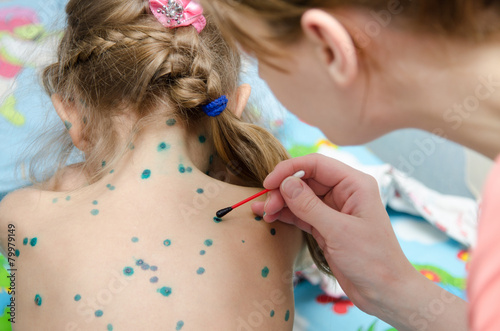 Fotografie Mom misses girl zelenkoj rash of chickenpox