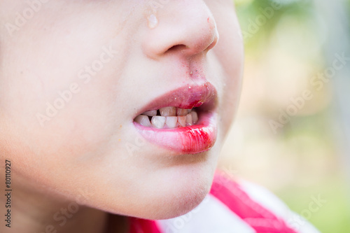 Little boy Bleeding at the mouth