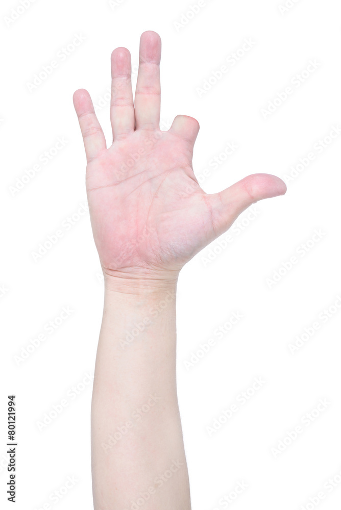 Disabled hand try to show the number five isolated on white back Disabled hand try to show the number five isolated on white back