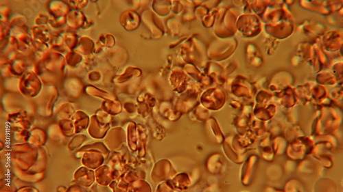 Blood Thickening 600x