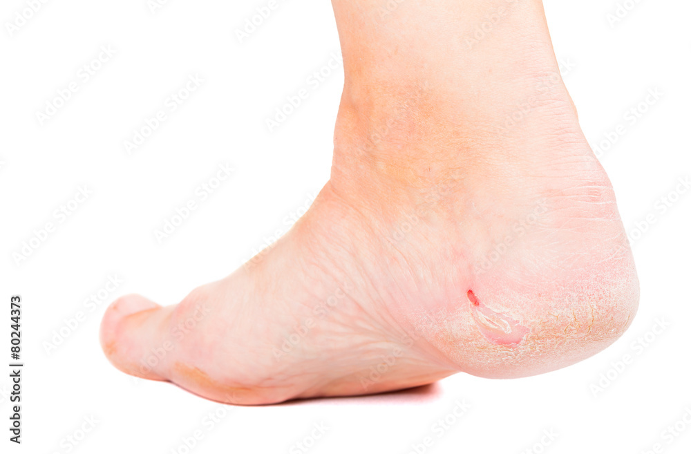 Naklejka premium Dry skin on heel