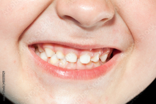 child teeth close up