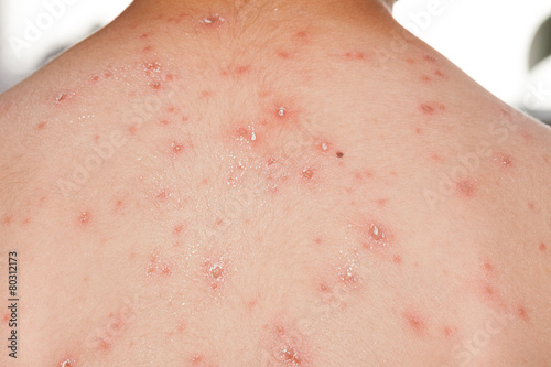 Detail baby with chicken pox rash