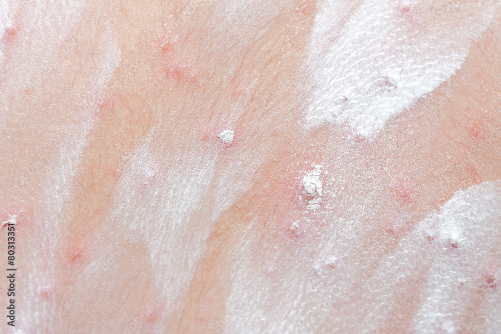 Detail baby with chicken pox rash