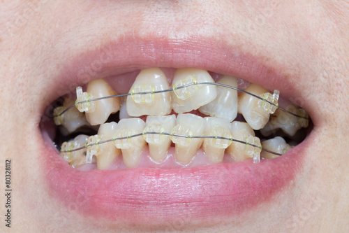 Close-up mouth of crooked teeth with braces