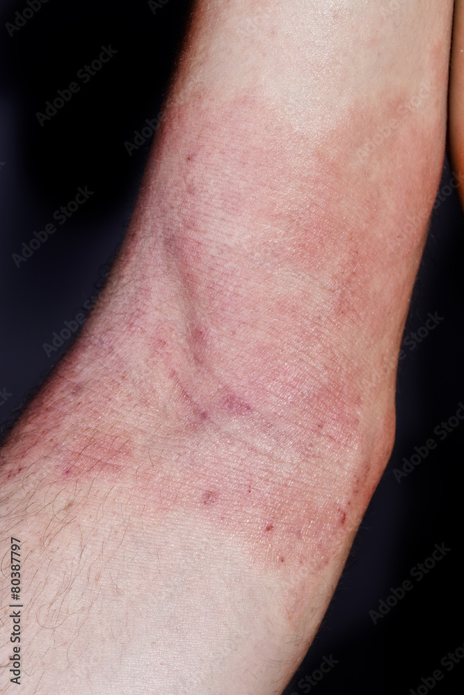 Fototapeta premium skin dermatitis