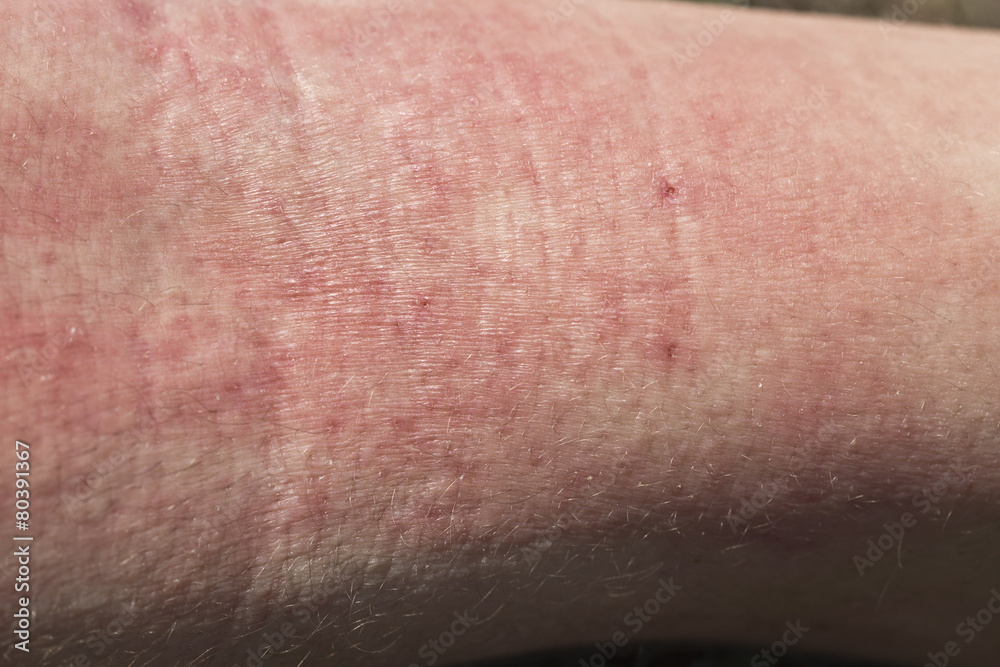 Fototapeta premium skin dermatitis