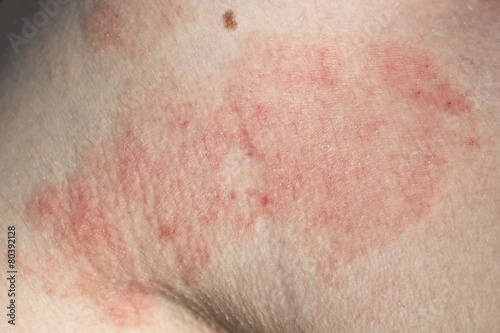skin dermatitis photo