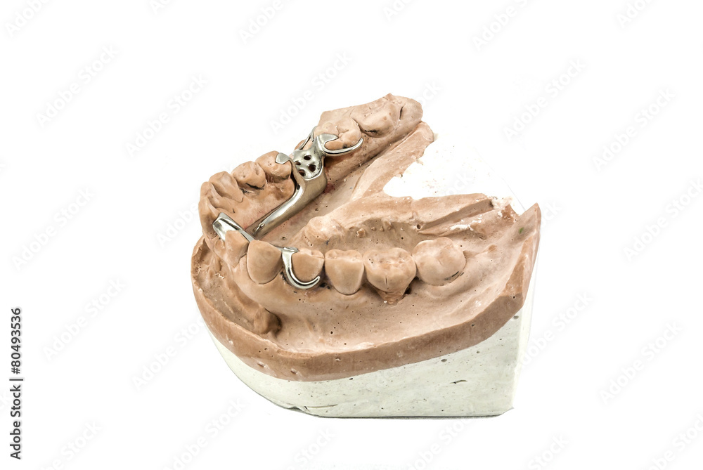 Dental cast with metal framework for partial denture Stock Photo