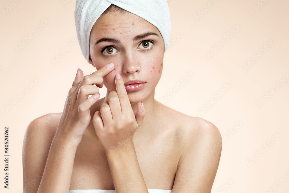 Acne spot pimple spot skincare beauty care girl Acne spot pimple spot skincare beauty care girl