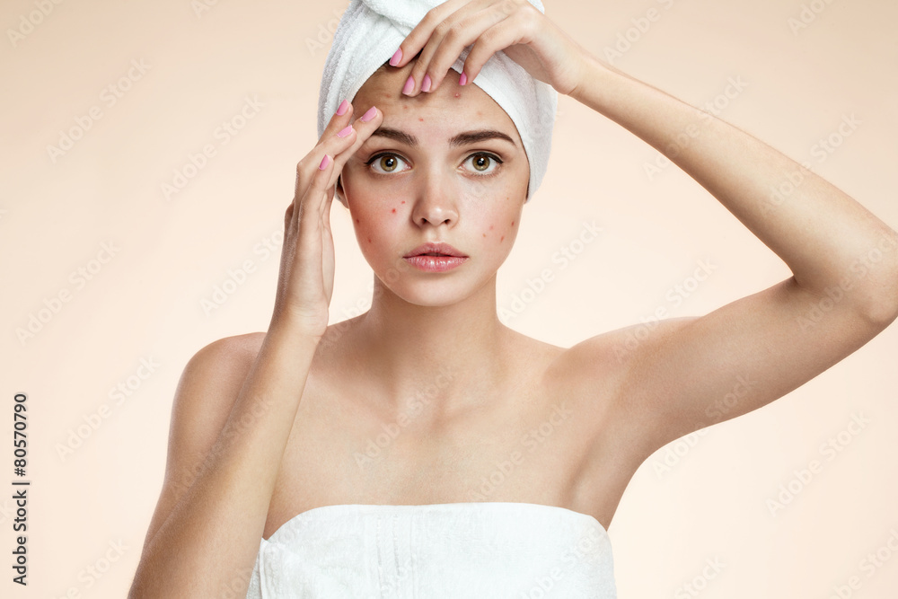 Young person squeezing pimples, removing pimple from her face Young person squeezing pimples, removing pimple from her face
