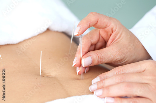 Fototapeta Naklejka Na Ścianę i Meble -  Acercamiento de las manos de una doctora llevando a cabo un tratamiento de acupuntura en el abdomen de una paciente