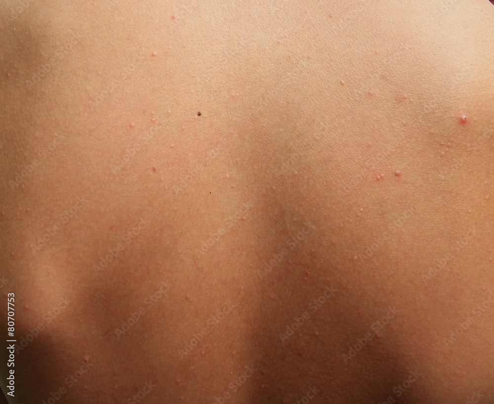 Boy with problematic skin and acne scars in the back