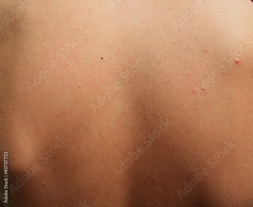 Boy with problematic skin and acne scars in the back photo