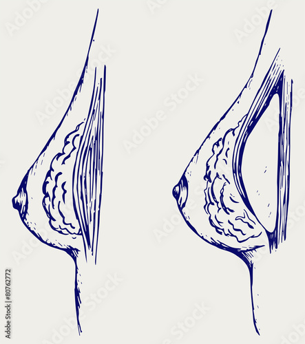 Plastic surgery. Breast implant. Doodle style