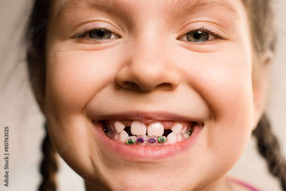 Girl with dental braces Girl with dental braces