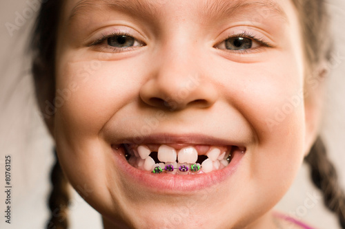 Girl with dental braces