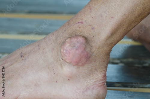 foot of patient with gout