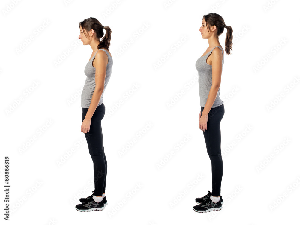 Woman with impaired posture position defect scoliosis and ideal - obrazy, fototapety, plakaty 