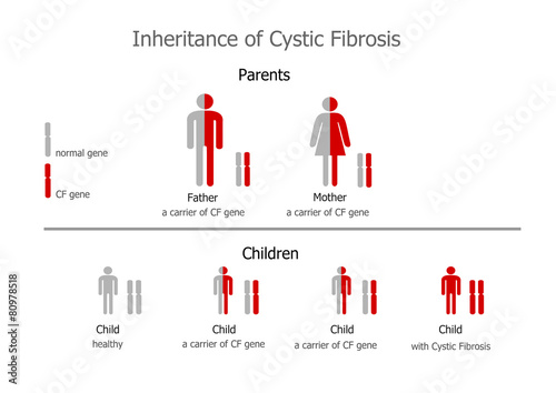 Cystic fibrosis (mucoviscidosis) - inheritance photo