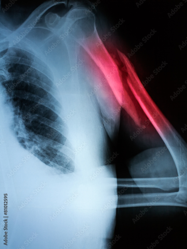 X-ray image of fracture of upper arm bone X-ray image of fracture of upper arm bone