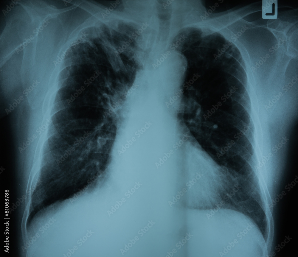 X-Ray Image Of Human Healthy Chest X-Ray Image Of Human Healthy Chest