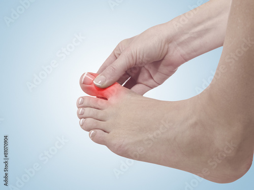 Painful and inflamed foot around the big toe area.