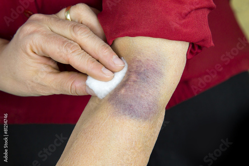 Large hematoma on human arm photo